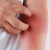 Eczema – Soaps to avoid